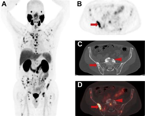 PET Imaging for Prostate Cancer | Radiology Key