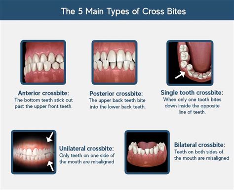 Crossbite Correction: Anterior vs. Posterior, Treatments, Cause (2022)