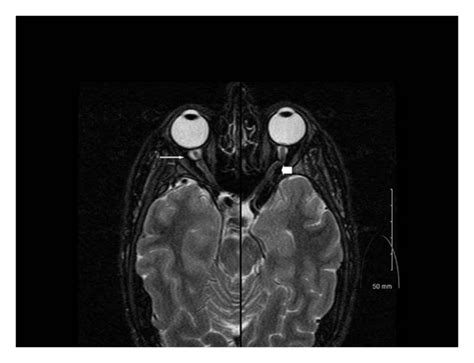 Nerve Sheath Tumor Mri