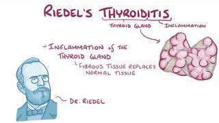 Thyroiditis Notes: Diagrams & Illustrations | Osmosis