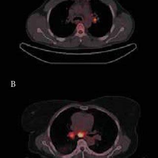 (a) PET-CT scan demonstrating a left hilar lymph node with positivity ...