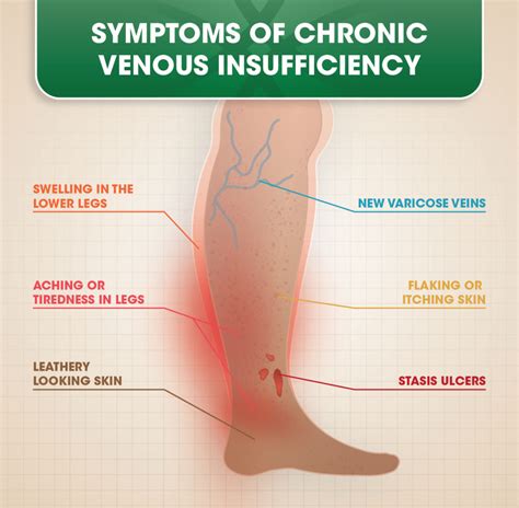 Chronic Venous Insufficiency (CVI) | DOC Vein Management