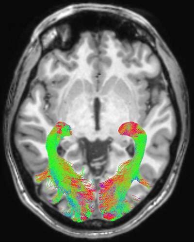 DWI-MRI shows vision changes could predict Parkinson's