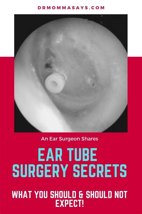 Ear Tube Surgery Secrets: What You Should and Should Not Expect - Dr ...