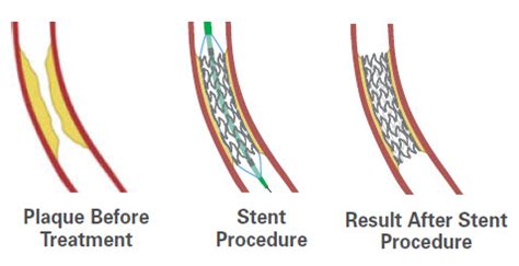 How coronary stents work - Boston Scientific