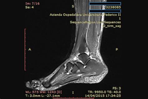 Psoriatic Arthritis in Ankle: Causes, Symptoms, and Treatment