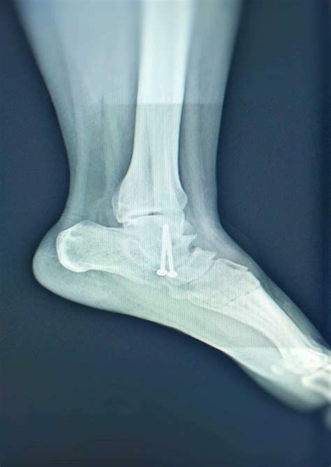 Subtalar Joint Arthritis: explained by a Foot Specialist