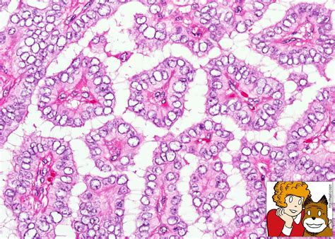 Pathology Outlines - Papillary thyroid carcinoma overview