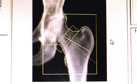 Osteoporosis scanning explained | Nuffield Health