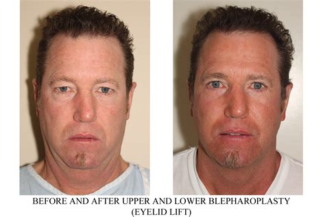 Before and After Upper Blepharoplasty - Dr. Andrew B. Denton