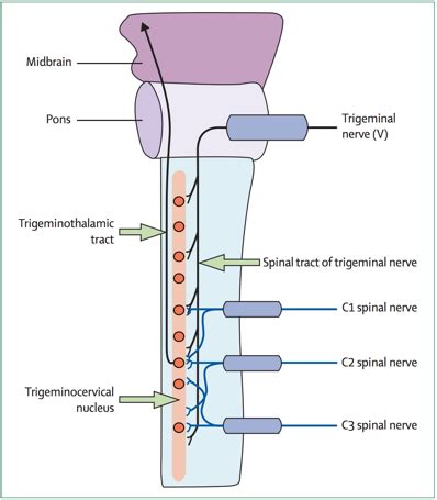 cervicogenic headache: causes, symptoms, diagnosis and treatment - Ryde ...