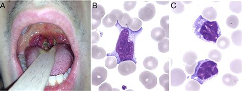 Mononucleosis Throat : Case 29 Fatigue Amboss - Kimberly Bight1981