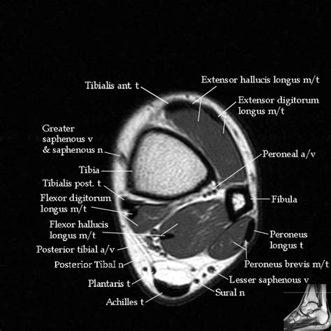 Knee Muscle Anatomy Mri Mri Knee Anatomy Knee Sagittal Anatomy 1240 ...