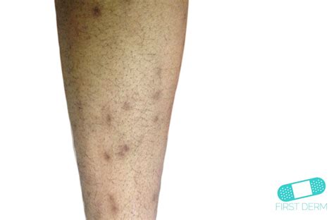 Online Dermatology - Hyperpigmentation : Causes, Types and Treatments