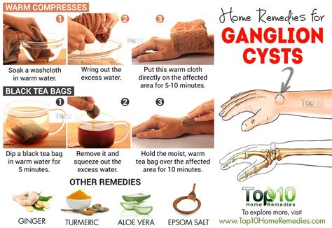 Home Remedies for Ganglion Cysts | Top 10 Home Remedies