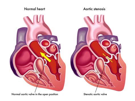 Facts About Aortic Stenosis - Dr. Peter Mikhail