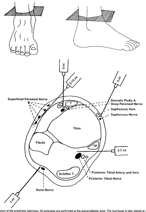 Figure 1 from Technique Tip: Supramalleolar Ankle Block Anesthesia and ...