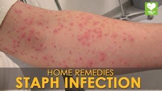 Best Ways To Get Rid Of Staph Infection