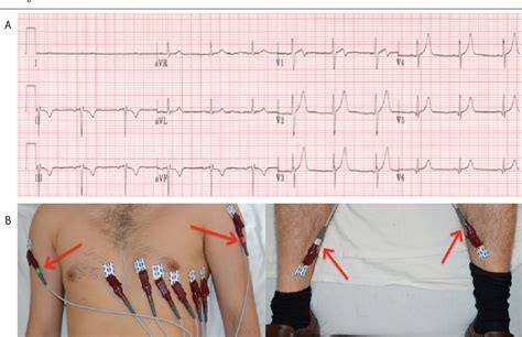 12 Lead Ecg Placement Mnemonic