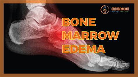 BONE MARROW EDEMA TREATMENTS - YouTube