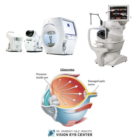 Glaucoma Treatment & Surgery - Vision Eye Center