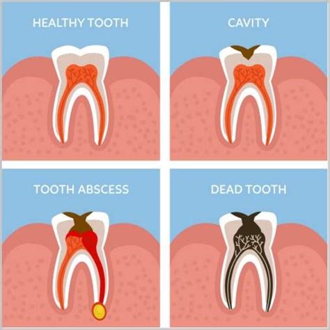 What To Do For A Broken Tooth With Exposed Nerve