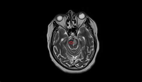 Acute Pontine Infarct MRI | Radiology Article on Acute Pontine stroke MRI