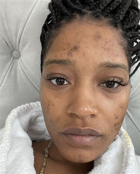 Keke Palmer shares how she covers acne scars after opening up about PCOS