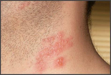 Shingles on neck pictures | Shingles Expert