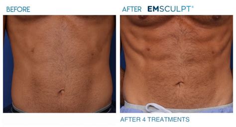 Renewal Skin Spa | Emsculpt-abs-before-and-after