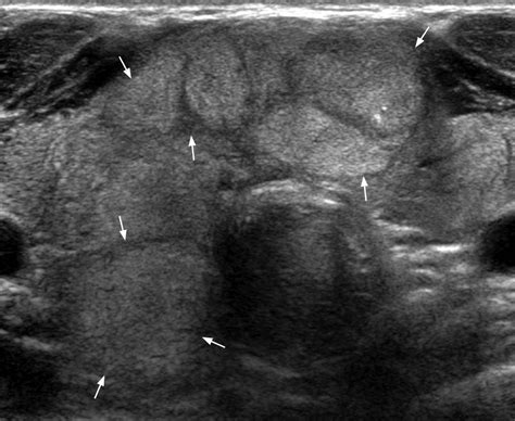 Thyroid Goiter Ultrasound