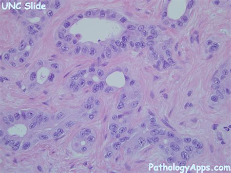 cholangiocarcinoma liver histology