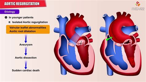 Wiggers Diagram Aortic Regurgitation