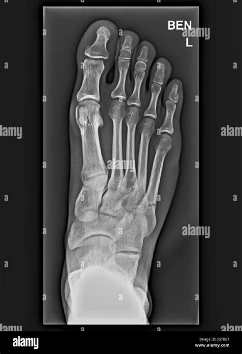 Foot Xray Anatomy