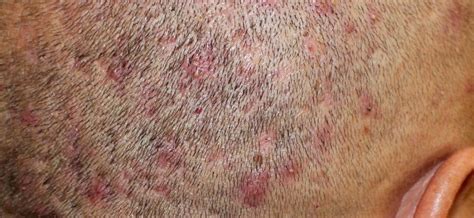 Folliculitis – causes, symptoms, treatment – Healthy Food Near Me