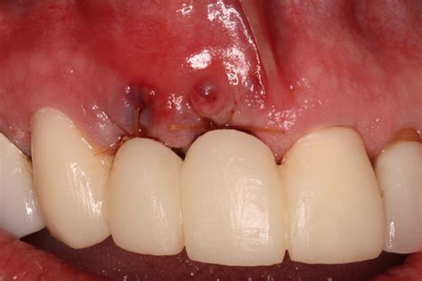 Front View-Bone Graft & Dental Implants - Ryan Lanman DDS, MSD