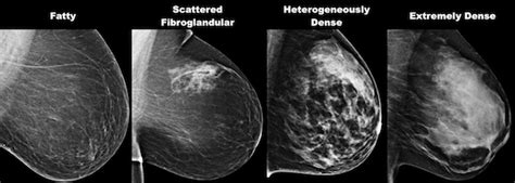 Mammography Test In Delhi, Digital Mammography, Breast Mammograms