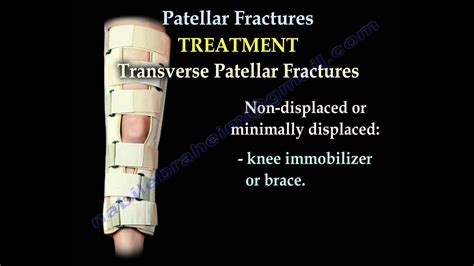 Patellar Fractures - Everything You Need To Know - Dr. Nabil Ebraheim ...