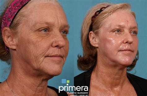 Chemical Peel Before and After Pictures Case 197 | Orlando, Florida ...