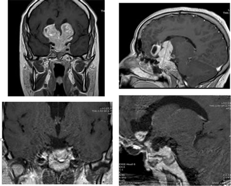 Coronal and sagittal planes from pituitary MRI of a giant prolactinoma ...