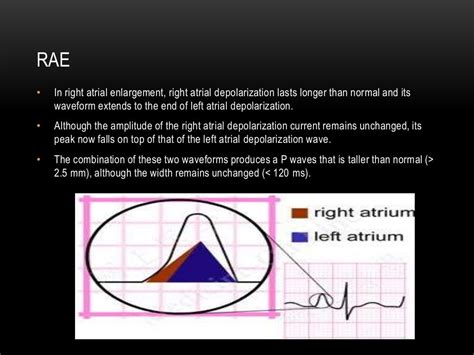 P wave axis and escape rhythms