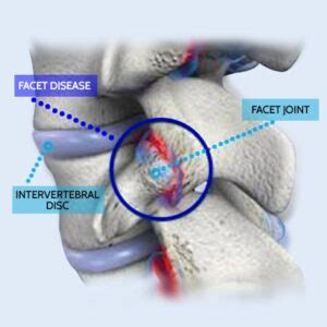 Facet Hypertrophy Treatment | Without Surgery Or Injections