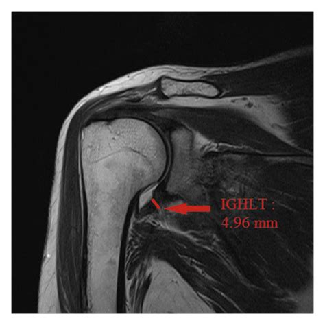 T2-weighted turbo-spin-echo coronal MR image in inferior glenohumeral ...