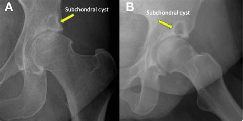 Subchondral Cyst