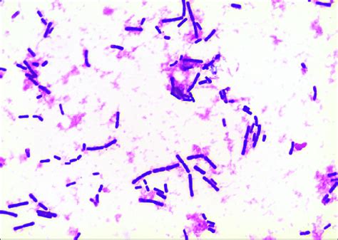 Gram stain of the positive anaerobic blood culture bottle showing ...