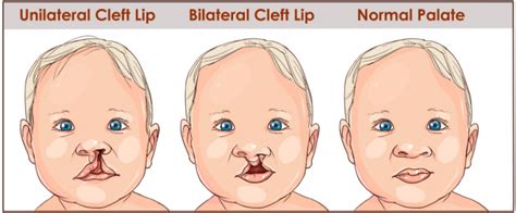 Cleft Palate: Causes, Treatment and Speech Therapy | Speech Blubs