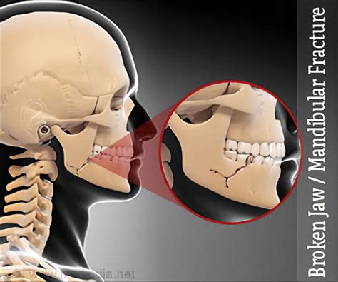 Maxillary Fracture