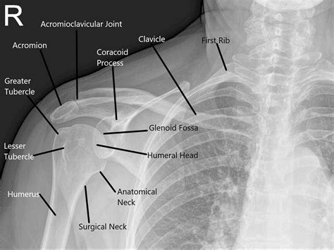 Snapping Shoulder - Causes & Management - Complete Orthopedics