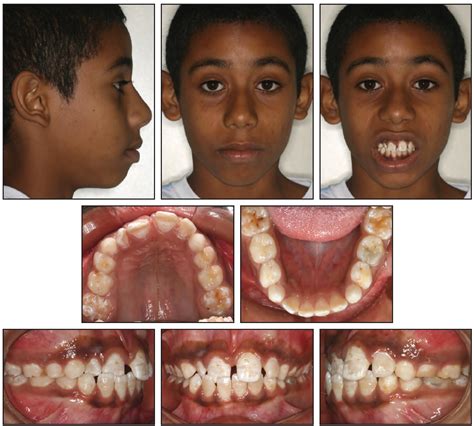 An Appliance for Treatment of Anterior Crossbite in an Epileptic ...