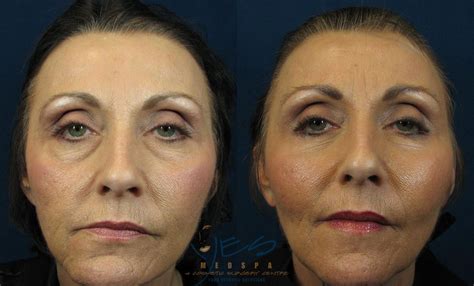 Lower Eyelid Blepharoplasty Before & After Photos Patient 41 ...